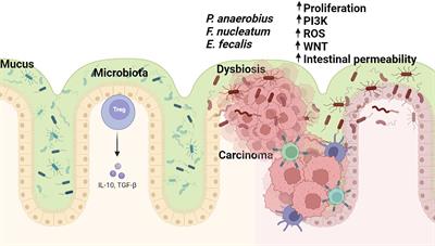 Contribution of Epithelial and Gut Microbiome Inflammatory Biomarkers to the Improvement of Colorectal Cancer Patients’ Stratification